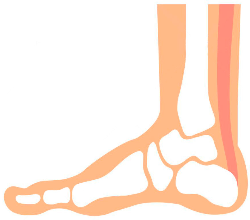 足の甲は尿酸塩の結晶がたまりやすい
