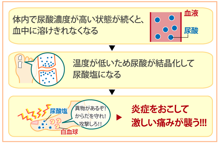 体内で尿酸濃度が高い状態が続くと、血中に溶けきれなくなる。温度が低いため尿酸が結晶化して尿酸塩になる。炎症をおこして激しい痛みが襲う!